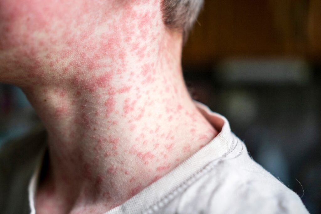 Measles Outbreak in West Texas